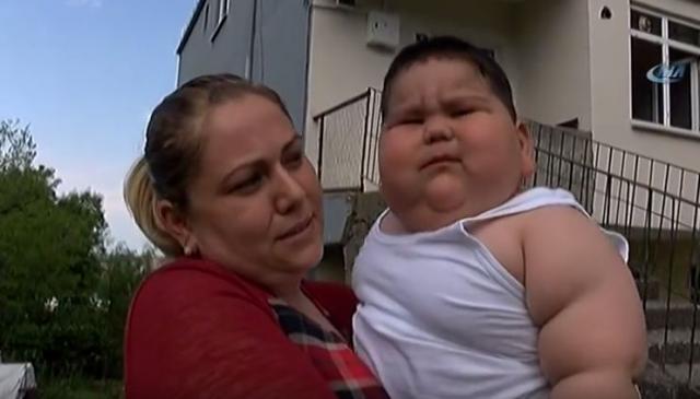 Redak poremećaj: Beba od godinu i po ima 32 kilograma